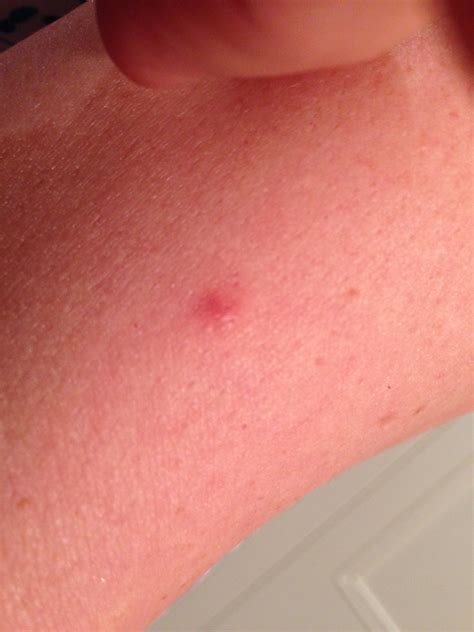 red spot on arm melanoma